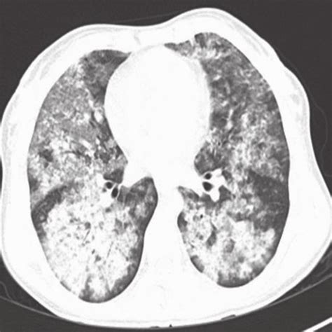 Computed Tomography Scan Chest Plain Showing Diffuse Multifocal