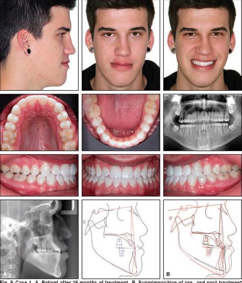 Figure 9 From Nonsurgical Correction Of Severe Skeletal Class Iii Malocclusion Semantic Scholar