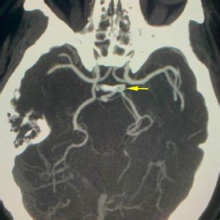 Axial Cta Demonstrating Fpca Cta Computed Tomography Angiography