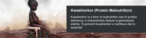 Kwashiorkor | Protein Malnutrition - Causes, Symptoms, Diagnosis ...