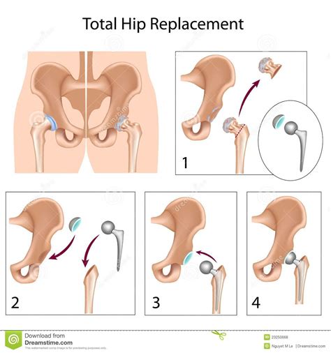Cirug A Total Del Reemplazo De La Cadera Ilustraci N Del Vector