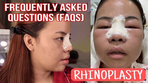 Faqs About My Rhinoplasty 👃🏼 Youtube