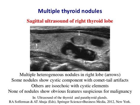 Thyroid Nodule Ultrasound