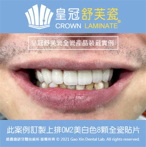 皇冠舒芙瓷｜美齒小故事 皇冠舒芙瓷 Crown Laminate 台灣全瓷假牙首選品牌