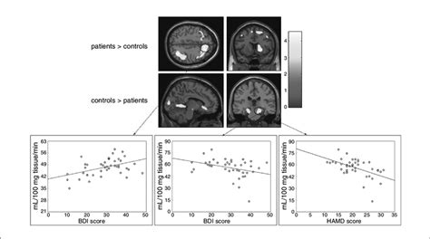 Regions With Abnormal Regional Cerebral Blood Flow RCBF In Patients