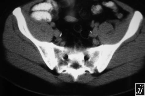 Right Iliac Bone Tumor T1 Radiopaedia