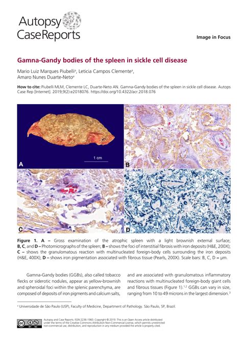 Pdf Gamna Gandy Bodies Of The Spleen In Sickle Cell Disease