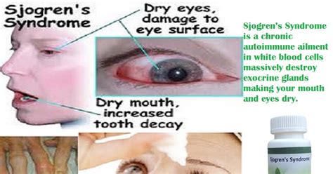 Sjogren's Syndrome Symptoms And Treatment