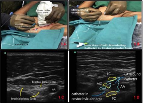 Scielo Brasil Ultrasound Guided Continuous Costoclavicular Block