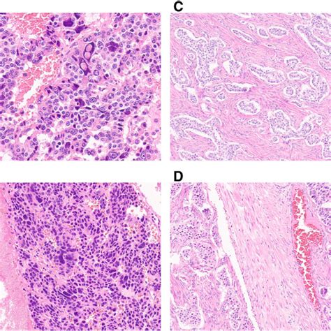 Pdf Primary Ovarian Neuroendocrine Tumor Arising In Association With