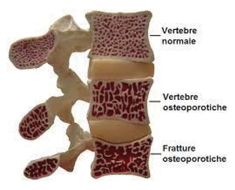 Vertebroplastica E Cifoplastica Roga