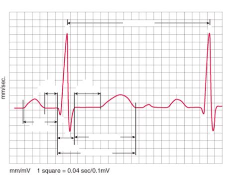 EKG: ID waves, segments, intervals Quiz