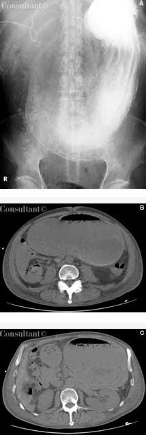 Gastric Outlet Obstruction Consultant360