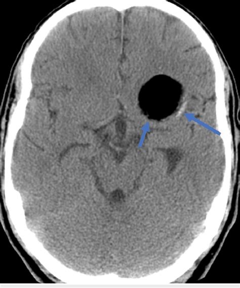 Brain Ct Revealing A Hypodense Lesion With Smooth Margins Having Cystic Download Scientific