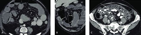 Computed Tomography Enterography Cte Examinations In A 44 Year Old