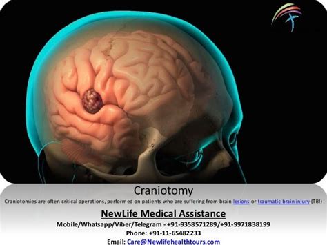 Craniotomy/Brain Tumor removal Surgery in India