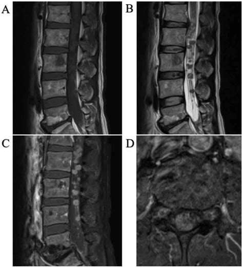 Intramedullary Spinal Cord Metastasis Of Malignant Melanoma Two Cases