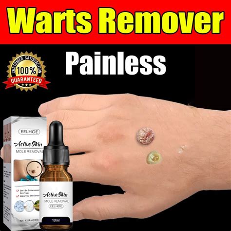 Warts Remover Warts Remover Original Mole And Warts Remover Kasoy Oil