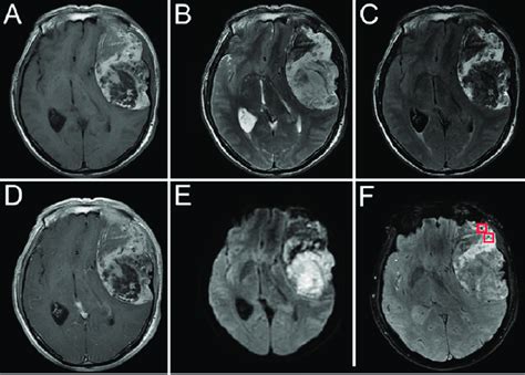 Axial T Wi A T Wi B And T Flair Imaging C Showing Mixed Signal