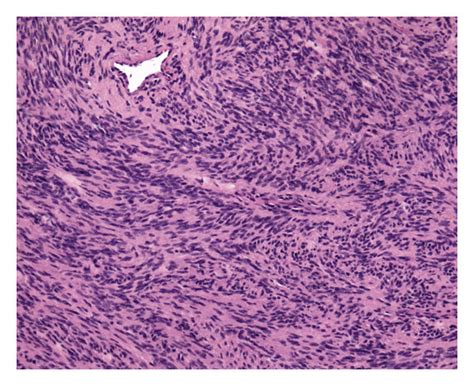 Histopathology Showing Monomorphic Spindle Cells With Oval Nuclei And