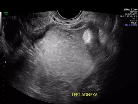 Ovarian Cyst Transabdominal Ultrasound