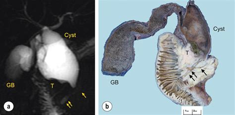 Benign Biliary Tract Diseases Clinical Tree