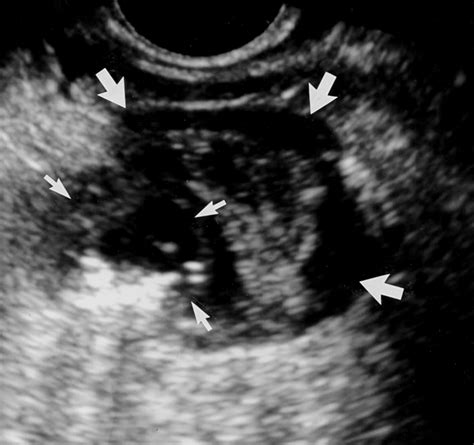 Diverticulitis Sigmoid Colon Icd 10 3
