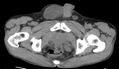 Ct Image Of A Patient With A Right Incarcerated Inguinal Hernia Download Scientific Diagram