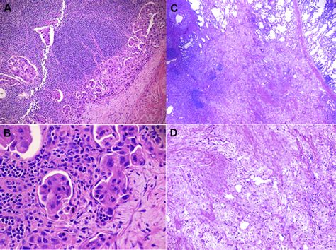 Precrizotinib Treatment And Postcrizotinib Treatment Hematoxylin And