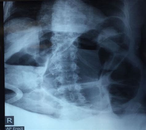 Abdominal X Ray Showing Sigmoid Volvulus With Steel Pan Pattern