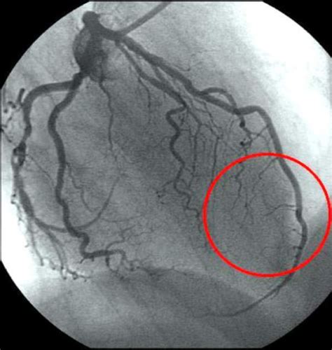 Angiography Of The Left Coronary Artery In Rao Projecti Open I