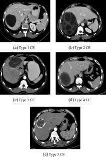 Application Of The Deep Transfer Learning Framework For Hydatid Cyst