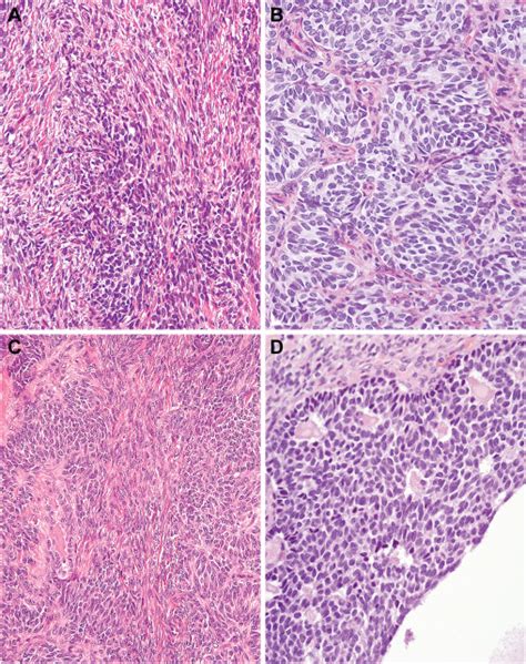 Testicular Neoplasms With Sex Cord And Stromal Components Harbor A