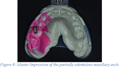 Figure 1 From Accuracy Of Digital Impressions At Varying Implant Depths