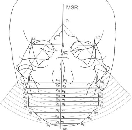 Cephalometric Graphical Evaluation Of The Exact Location Of Transverse