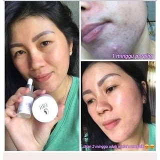 Jual Paket Ultimate Serum Nbs Shopee Indonesia