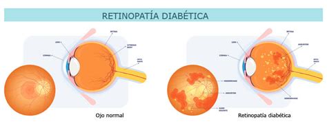 Retina Qu Es Y Cuales Son Las Enfermedades M S Comunes Opeluce