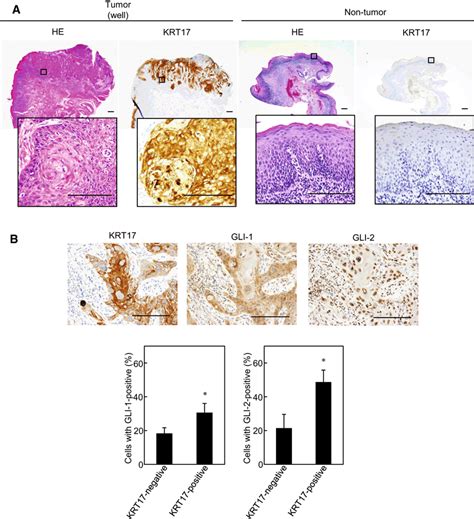 Krt Gli Or Gli Is Expressed In Human Osccs A B Oscc Tissues