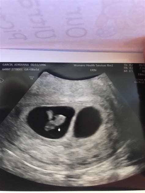 6 Week Ultrasound Twins One Sac