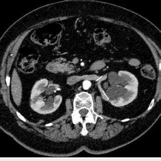 An Axial Cross Sectional Enhanced Abdominal Computed Tomography CT