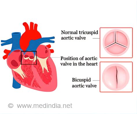 Bicuspid Valve