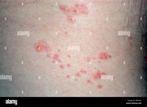 Dermatomes ausschlag Fotos und Bildmaterial in hoher Auflösung Alamy