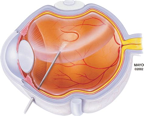 Retinal Detachment Imaging Of Surgical Treatments And Complications