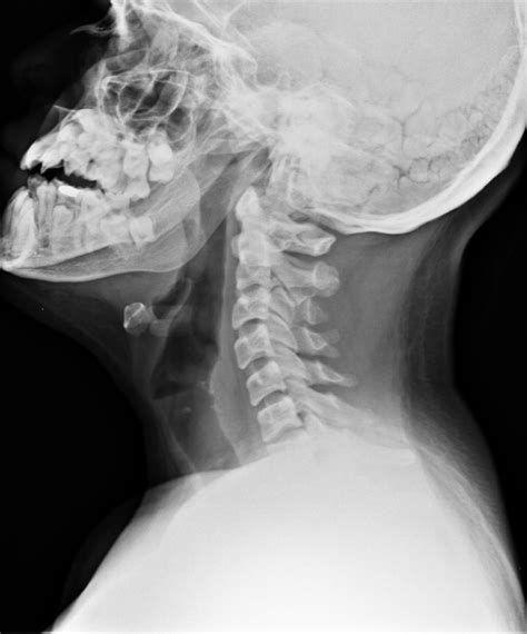 Cleidocranial Dysostosis Image