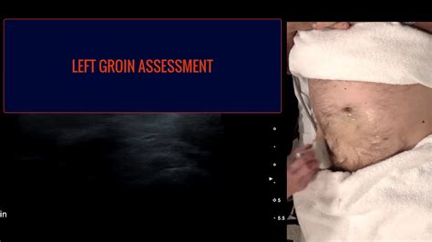 Groin Hernia Ultrasound Part 2 Youtube