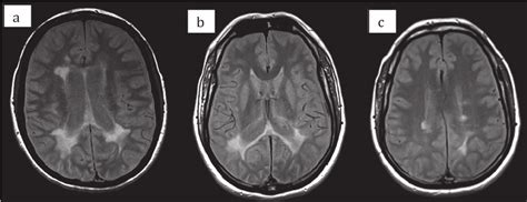 Brain Mri Axial Sections Pd A Case No Multiple Demyelinating