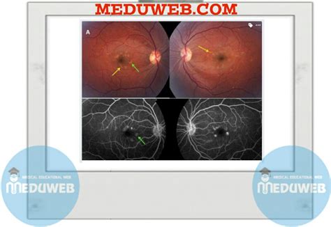 Myotonic dystrophy - Meduweb