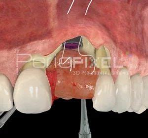 Vídeo 3D de implante dental inmediato con injerto de tejido conectivo