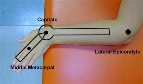 Ulnar Deviation And Ulnar Drift Definition And Causes