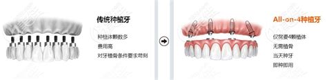 长沙半全口种植牙的价格表有调整涉及allon46即刻种植体的费用 美佳社区